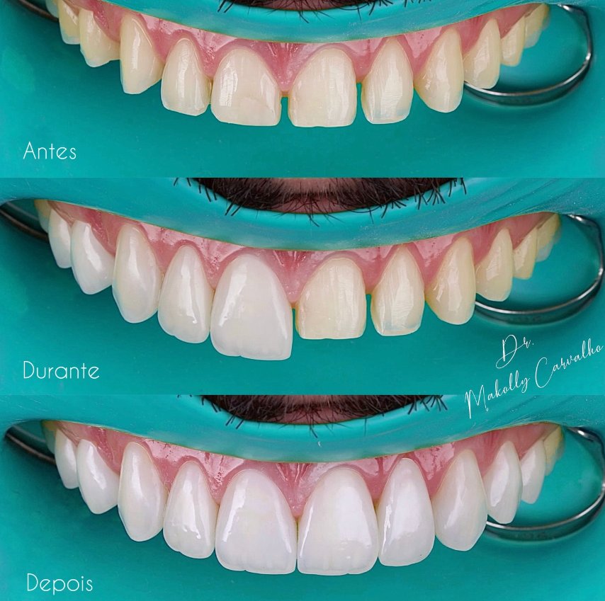 Lentes de contato dental, antes, durante e depois, por Dr. Makolly Carvalho em São Luís MA
