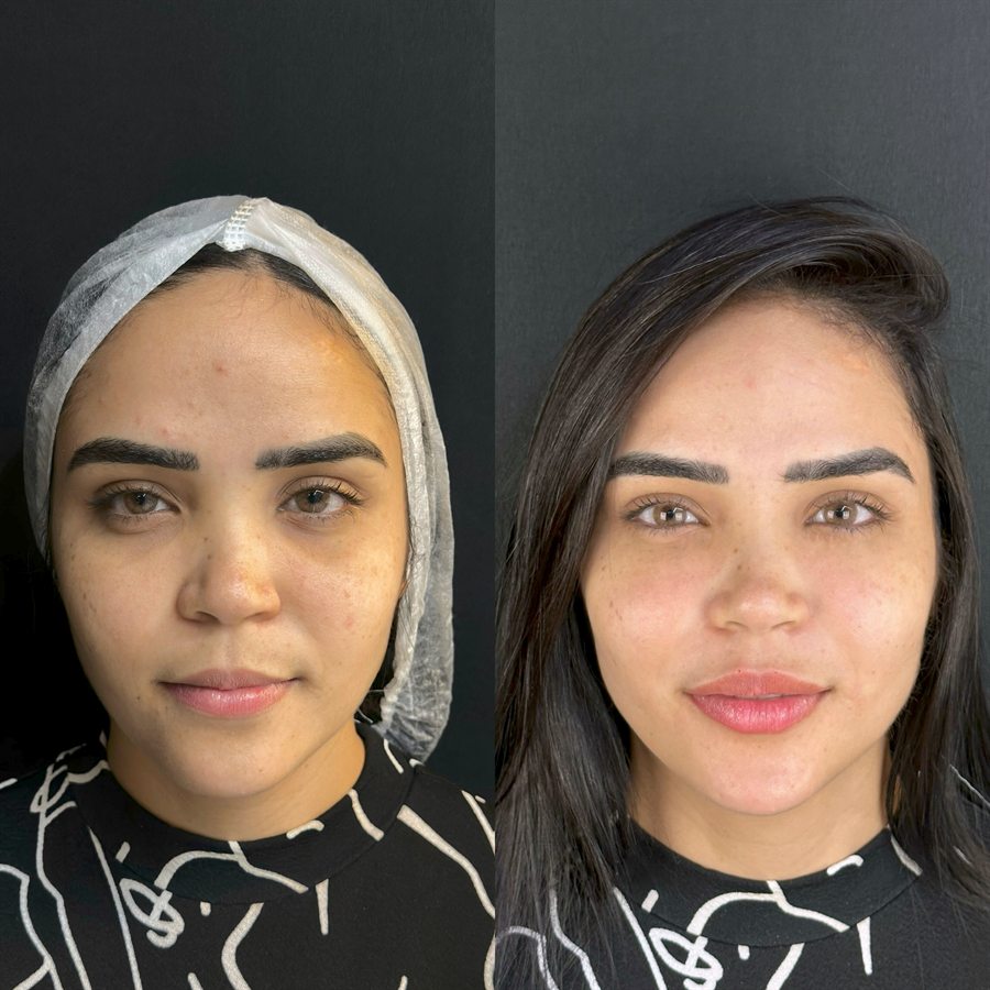 Harmonização facial, antes e depois, por Dr. Makolly Carvalho em São Luís MA