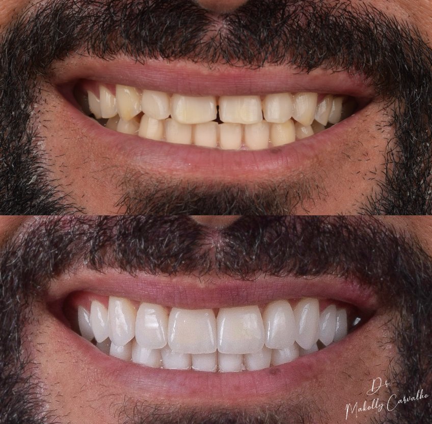 Lentes de contato dental, antes e depois, por Dr. Makolly Carvalho em São Luís MA