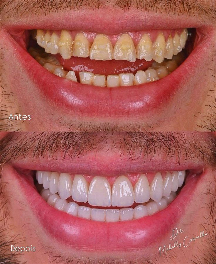 Lentes de contato dental, antes e depois, por Dr. Makolly Carvalho em São Luís MA