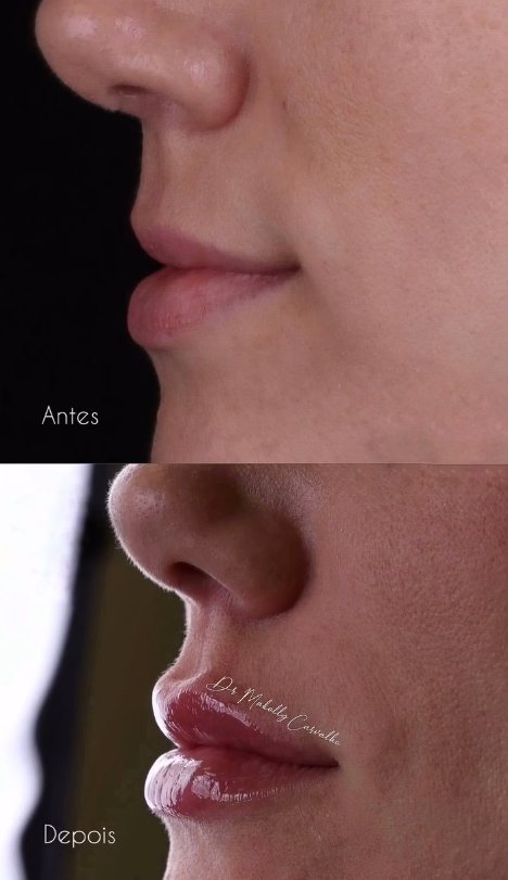 Preenchimento labial, antes e depois, por Dr. Makolly Carvalho em São Luís MA