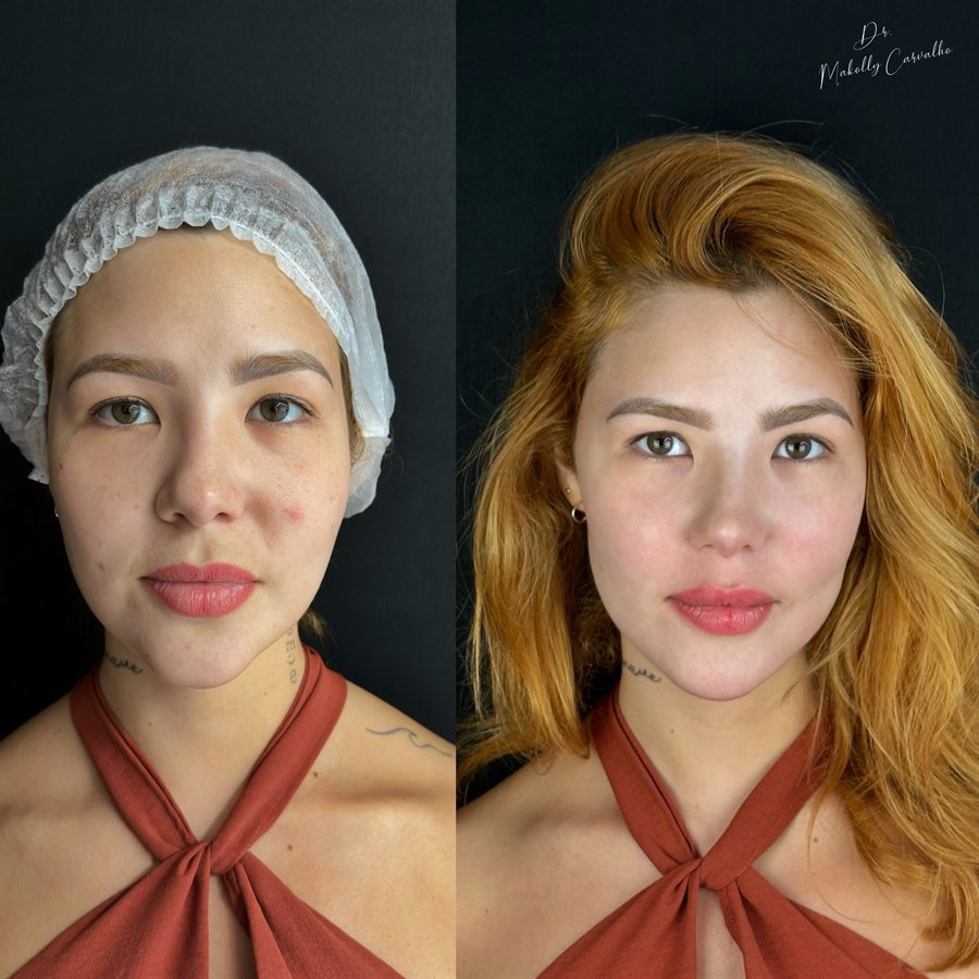 Harmonização facial, antes e depois, por Dr. Makolly Carvalho em São Luís MA