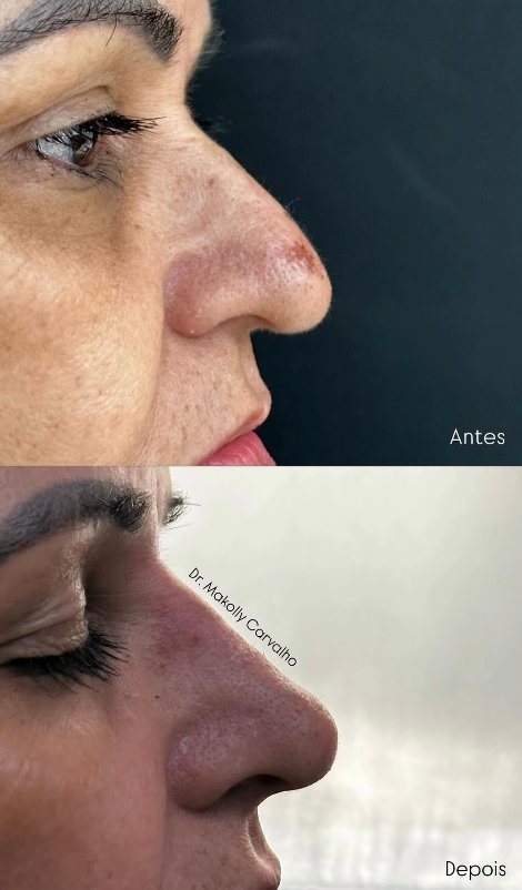 Rinomodelação, antes e depois, por Dr. Makolly Carvalho em São Luís MA