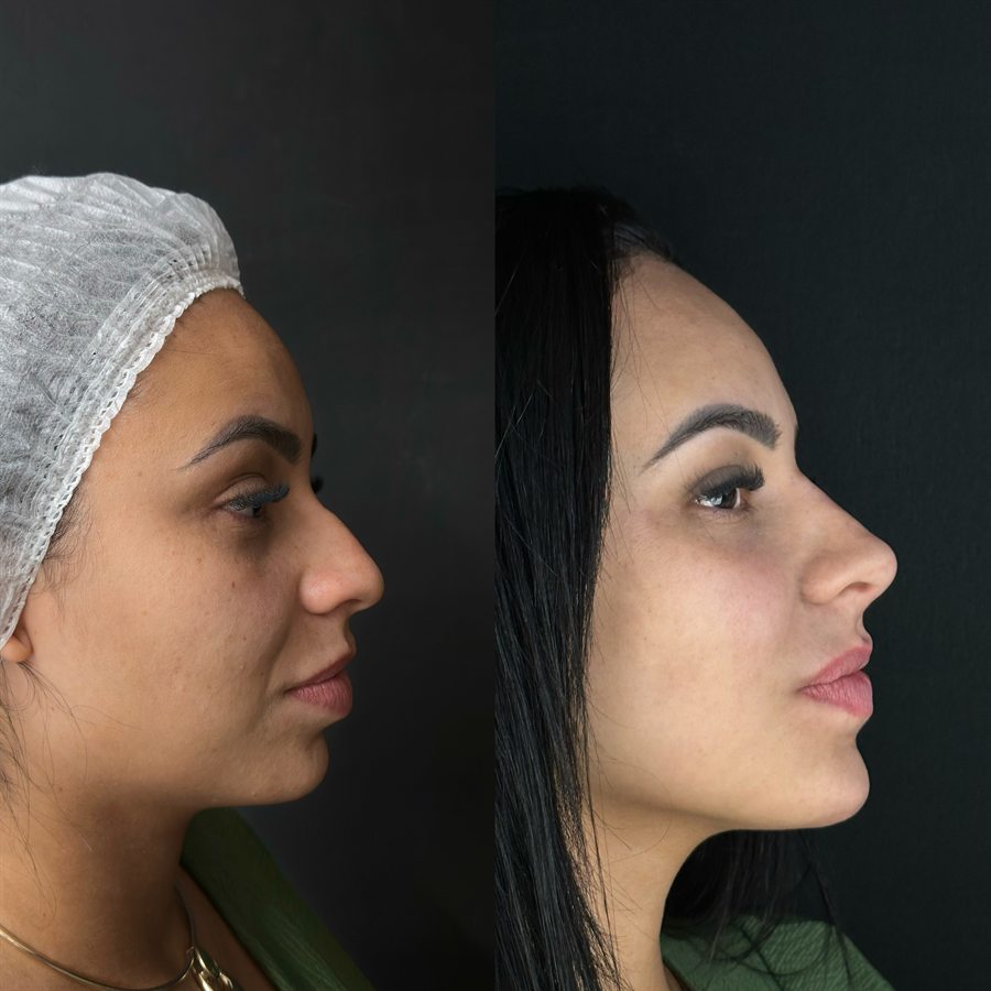 Rinomodelação, antes e depois, por Dr. Makolly Carvalho em São Luís MA