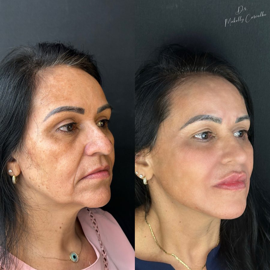 Harmonização facial, antes e depois, por Dr. Makolly Carvalho em São Luís MA