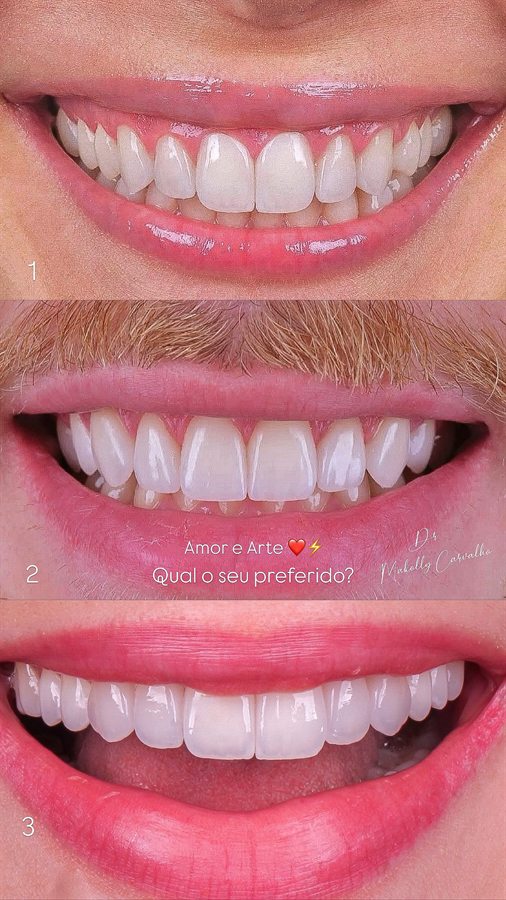 Lentes de contato dental, três sorrisos, por Dr. Makolly Carvalho em São Luís MA